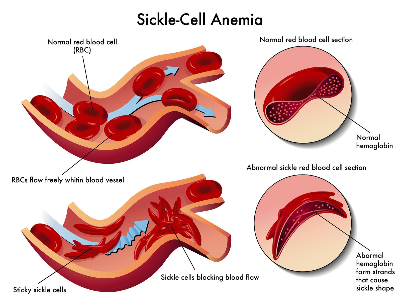 anemia