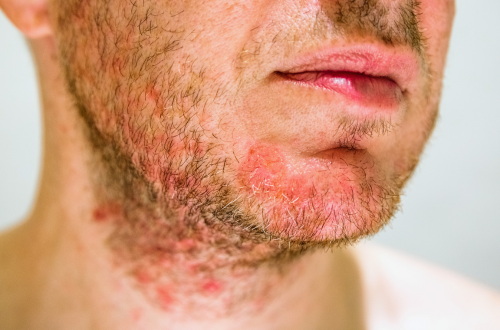 Acne vs. contact dermatitis (1).png