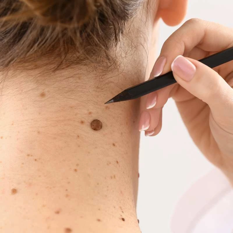 See our lesion removal prices  - call today for a free quote