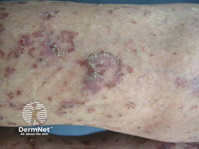 Scabies
Limb lesions in crusted scabies