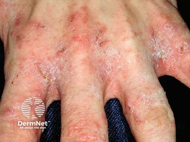Scabies burrows between fingers showing thin grey lines, redness, and crusting.