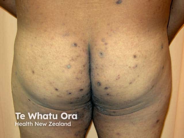 Nodular scabies lesions on genital skin