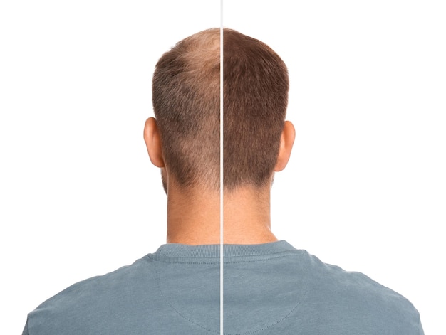Photo man with hair loss problem before and after treatment on white background collage visiting trichologist