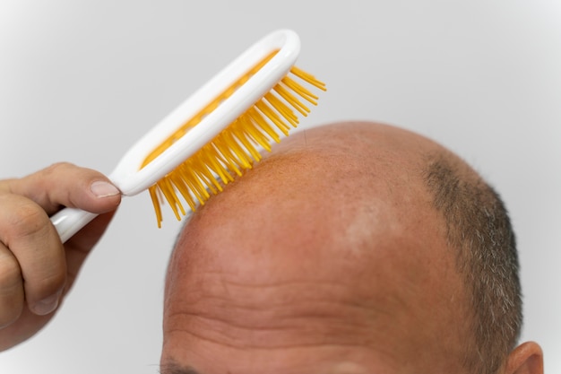 Free photo bold man needing a follicular unit extraction